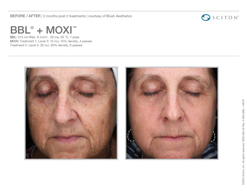 MOXI laser treatment Westminster, CO