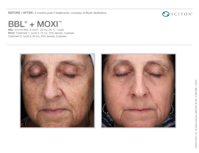 2600-062-82 Rev A BBL + MOXI_page-0001 MOXI laser treatment Westminster, CO