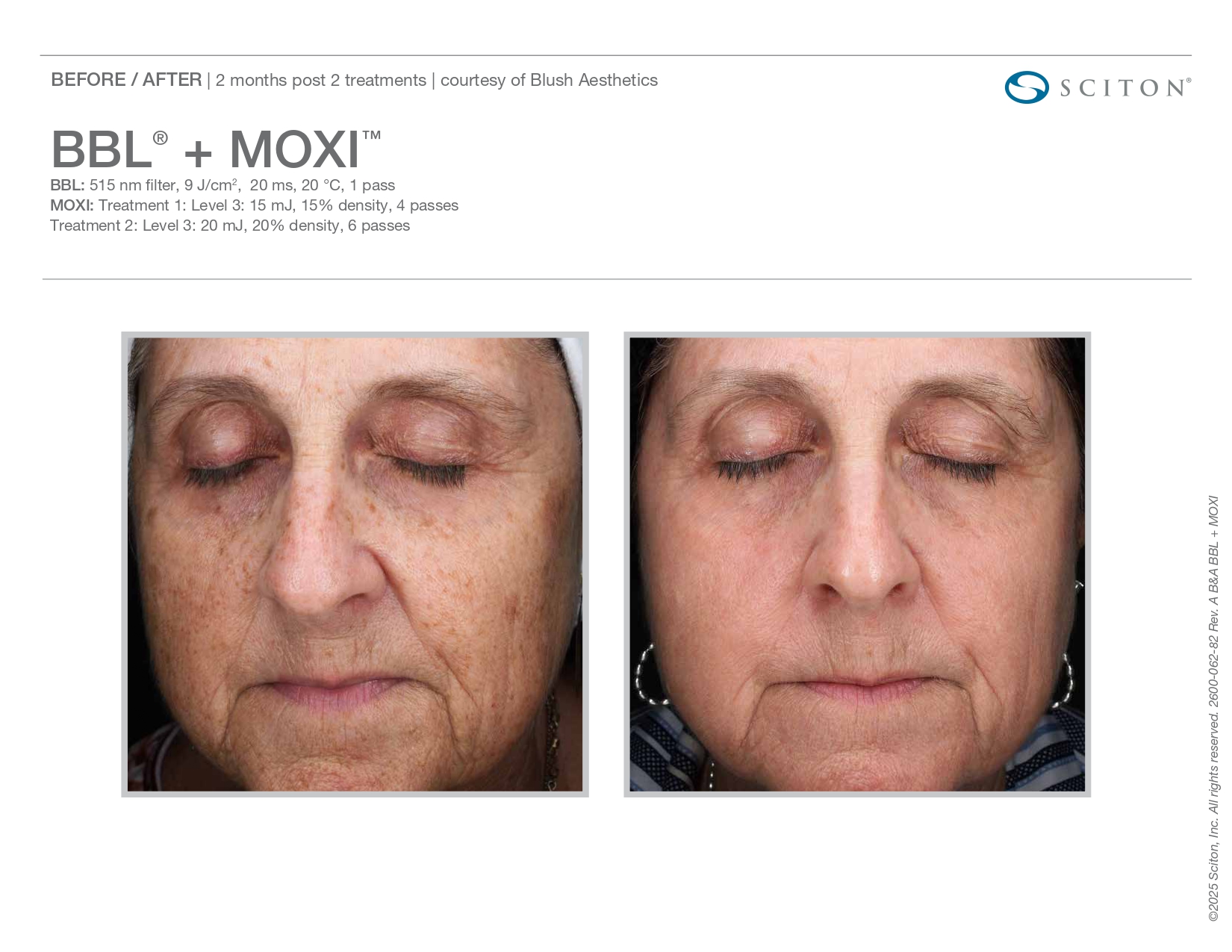 MOXI laser treatment Westminster, CO