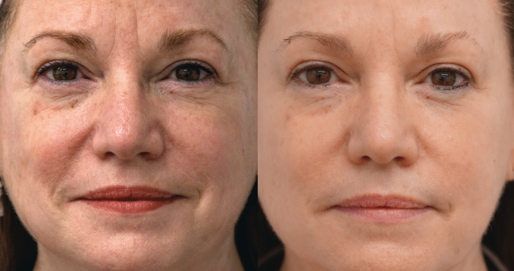 BBL HEROic light therapy treatment in Westminster, Colorado